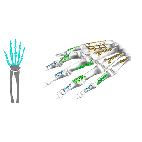 Combo 1,2 | 1,7 | 2,3mm
